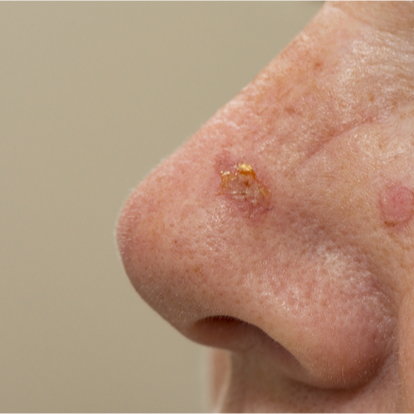 Actinic Keratoses Actinic Keratoses