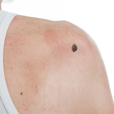 Squamous Cell Carcinoma 