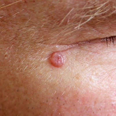 Basal Cell Carcinoma